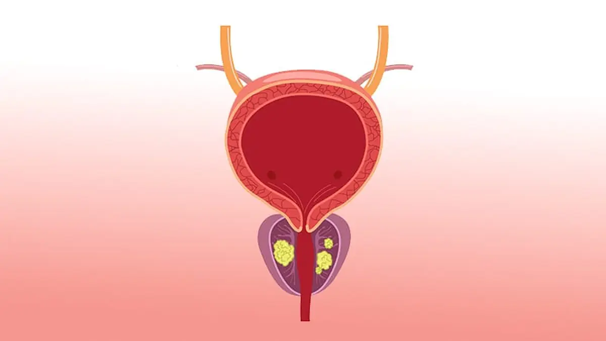 Shorter Prostate RT Holds Up at 5 Years, With Caveats
