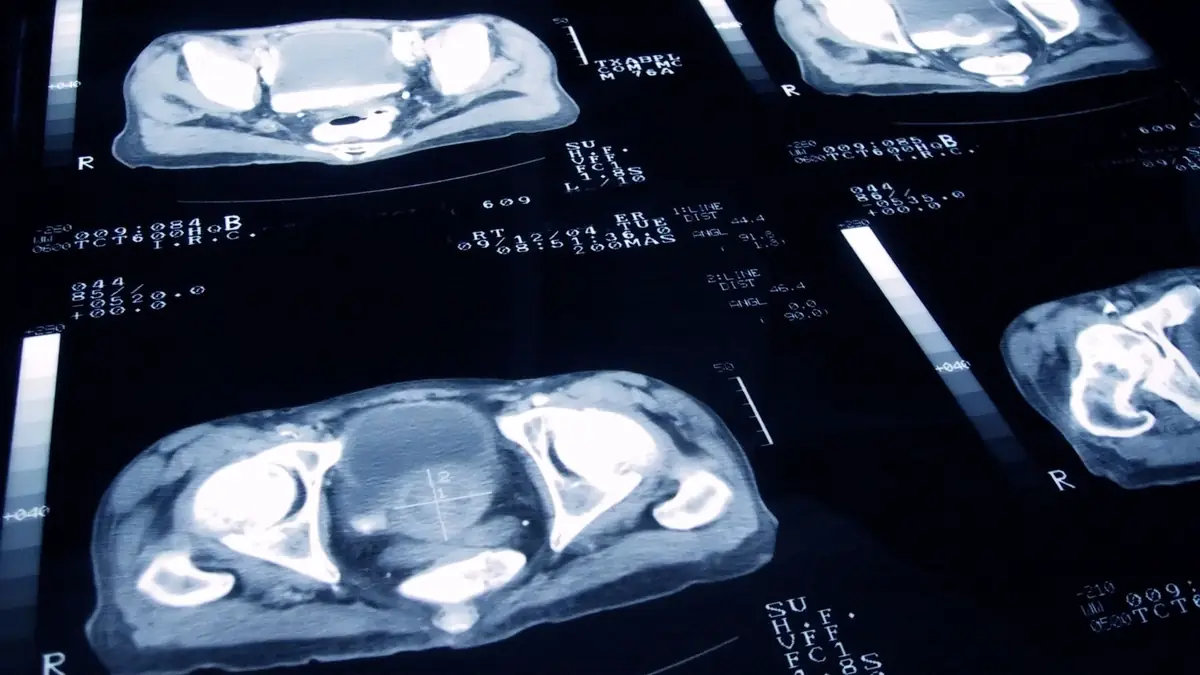 Vital clues could help predict prostate cancer years in advance, study suggests